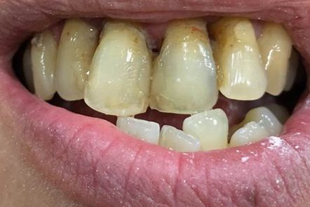 Στεφανες μεταλλοπορσελανης Α1!!!