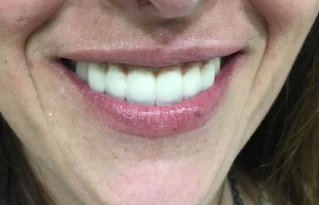 Στεφανες μεταλλοπορσελανης Α1!!!