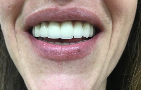 Στεφανες μεταλλοπορσελανης Α1!!!