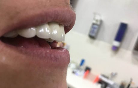 Στεφανες μεταλλοπορσελανης Α1!!!