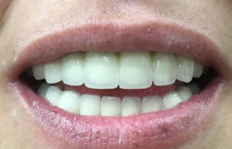 Στεφανες μεταλλοπορσελανης Α1!!!